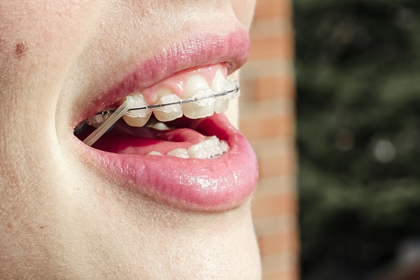 Who Is A Good Candidate For Ceramic Braces?