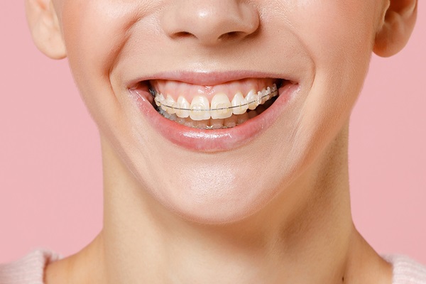 Tips For Knowing Whether Ceramic Braces Are Right For You