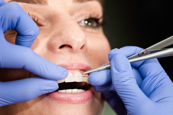 What To Know Before Getting Ceramic Braces