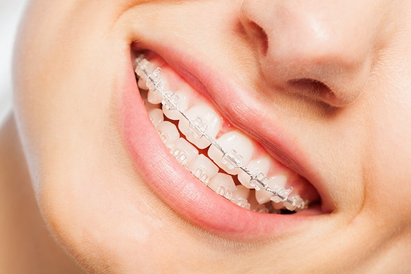 Consider Clear Braces For Straighter Teeth