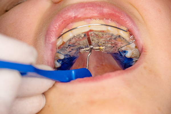 https://www.bracesbyabbadent.com/wp-content/uploads/palatal-expander-2308.jpg